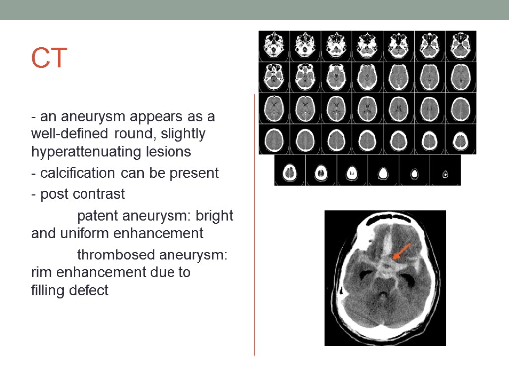 CT - an aneurysm appears as a well-defined round, slightly hyperattenuating lesions - calcification